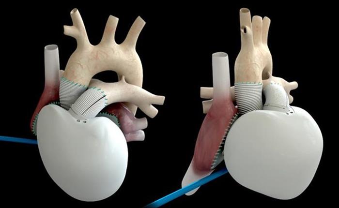 Μόνιμη τεχνητή καρδιά, το μέλλον των καρδιοπαθών