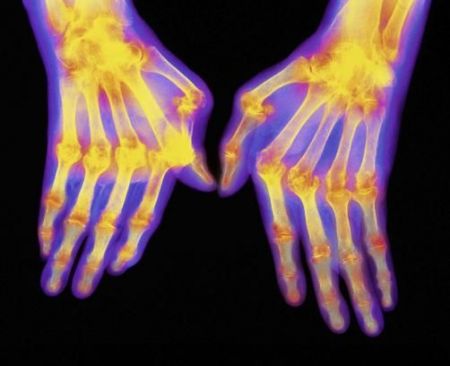 Γενετικός «θησαυρός» – ελπίδα ενάντια στην αρθρίτιδα