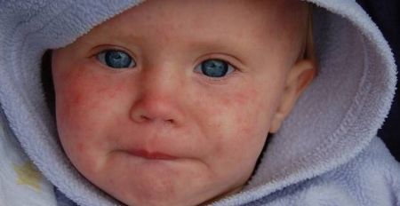 Πειραματικό φάρμακο υπόσχεται προστασία από την ιλαρά