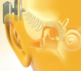 Μαγνητικό εμφύτευμα χαρίζει ακοή