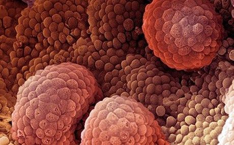 Ελπίδες για ανάπτυξη διαγνωστικού τεστ για τον καρκίνο του προστάτη