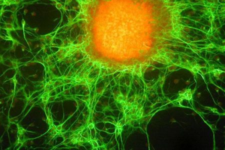 Βλαστοκυτταρικές «μηχανές εξόντωσης» του καρκίνου