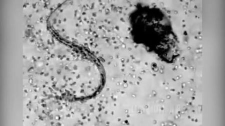 Στρατός λευκών αιμοσφαιρίων επιτίθεται σε παράσιτο