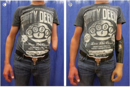 Εφαρμόστηκε για πρώτη φορά η «βιονική ανακατασκευή»