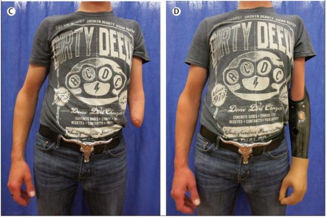 Εφαρμόστηκε για πρώτη φορά η «βιονική ανακατασκευή»