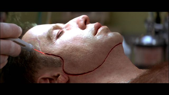 Μεταμόσχευση κεφαλιού σε νέο σώμα υπόσχεται ιταλός χειρουργός