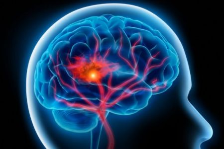 Το εγκεφαλικό γερνάει το μυαλό κατά 8 χρόνια