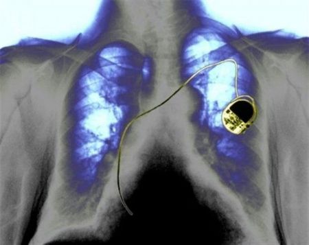 Μακριά από κινητά και ηλεκτρικά πεδία οι βηματοδότες