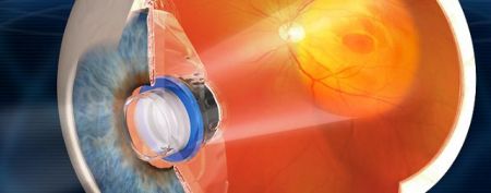 Επαναστατική θεραπεία για την εκφύλιση ωχράς κηλίδας