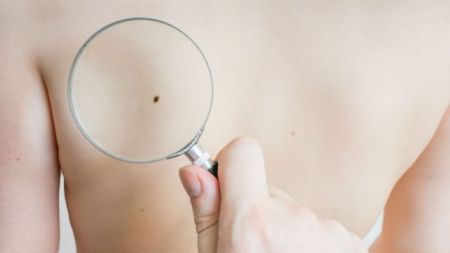 Νέα μέθοδος διάγνωσης καρκίνου του δέρματος
