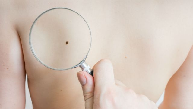Νέα μέθοδος διάγνωσης καρκίνου του δέρματος