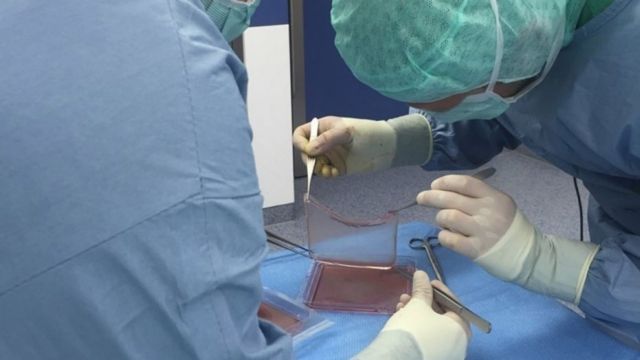 Μεταμόσχευσαν νέα επιδερμίδα σε επτάχρονο