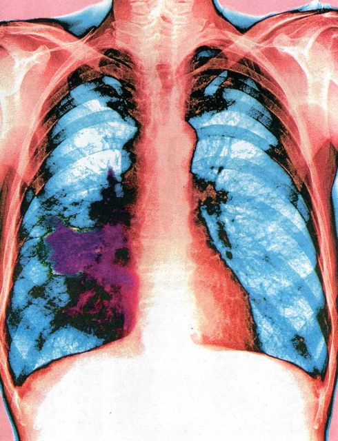 Ευρωπαϊκό «ναι» σε φάρμακο για τον καρκίνο του πνεύμονα