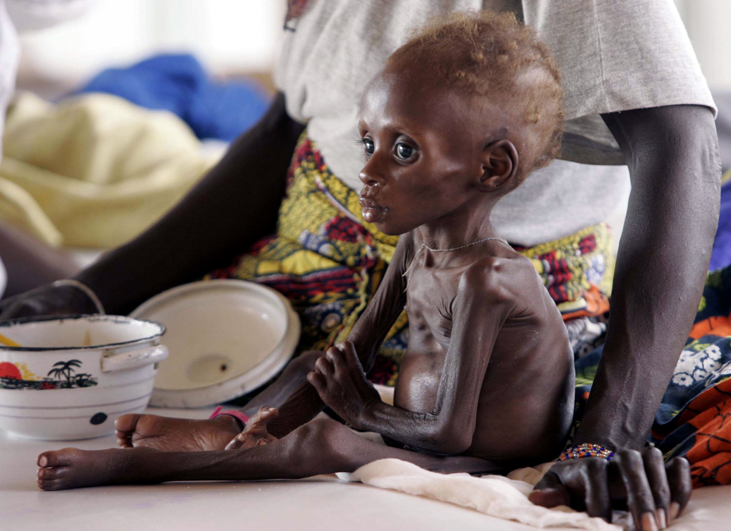 Υψηλός ο αριθμός υποσιτισμένων παιδιών σε Αφρική και Ασία