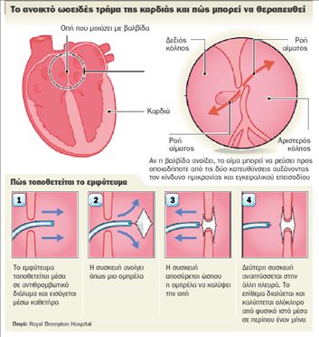 Συσκευή «κλείνει» την τρύπα της καρδιάς