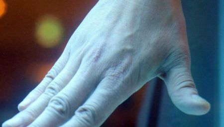 Αντιμετώπιση του καρκίνου του δέρματος με σύστημα τεχνητής νοημοσύνης