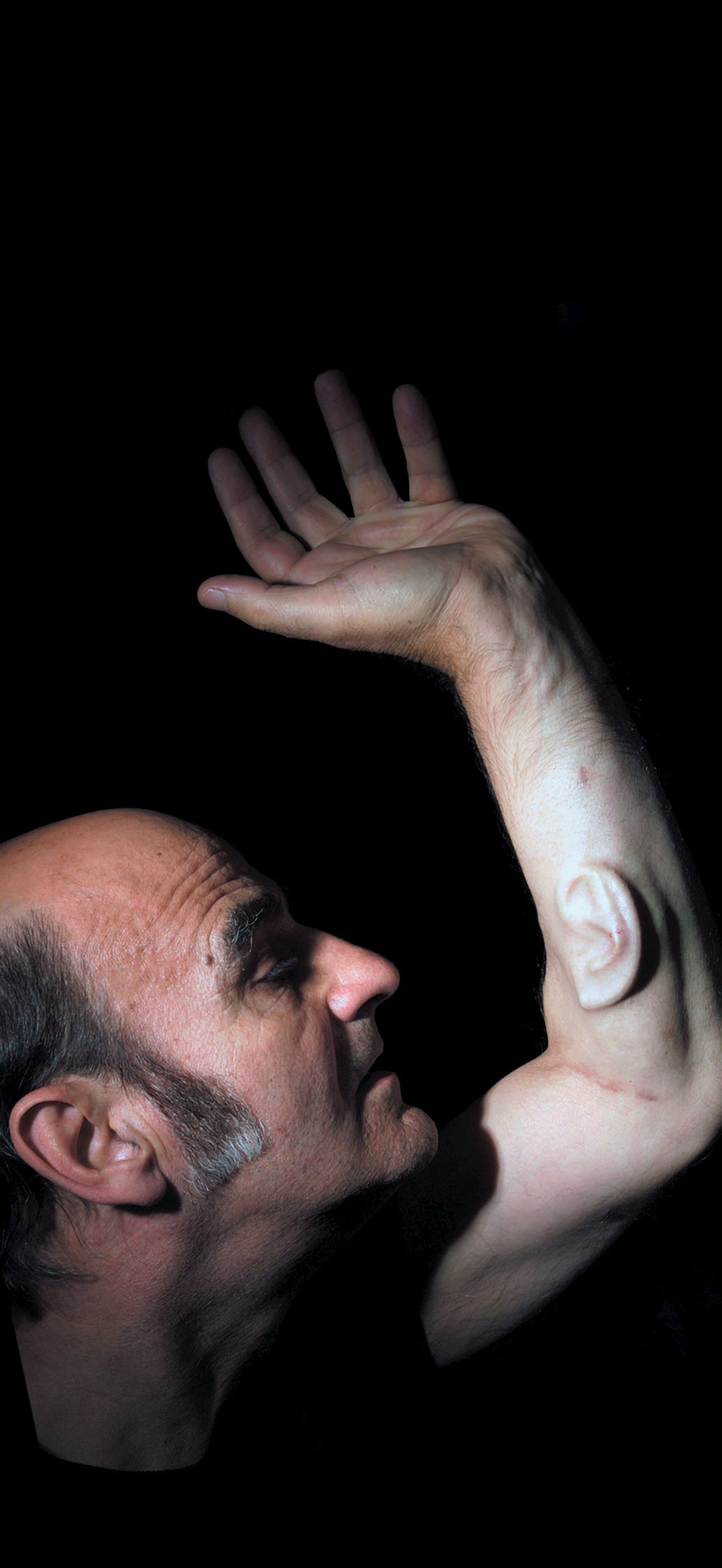 Ομογενής από την Αυστραλία φύτεψε αυτί στο χέρι του!