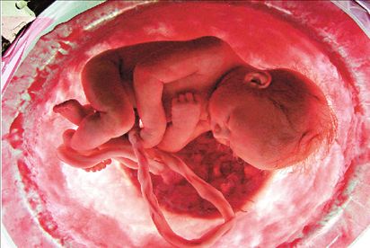 Μεσογειακή αναιμία  Στα έμβρυα κρύβεται η θεραπεία; | tovima.gr