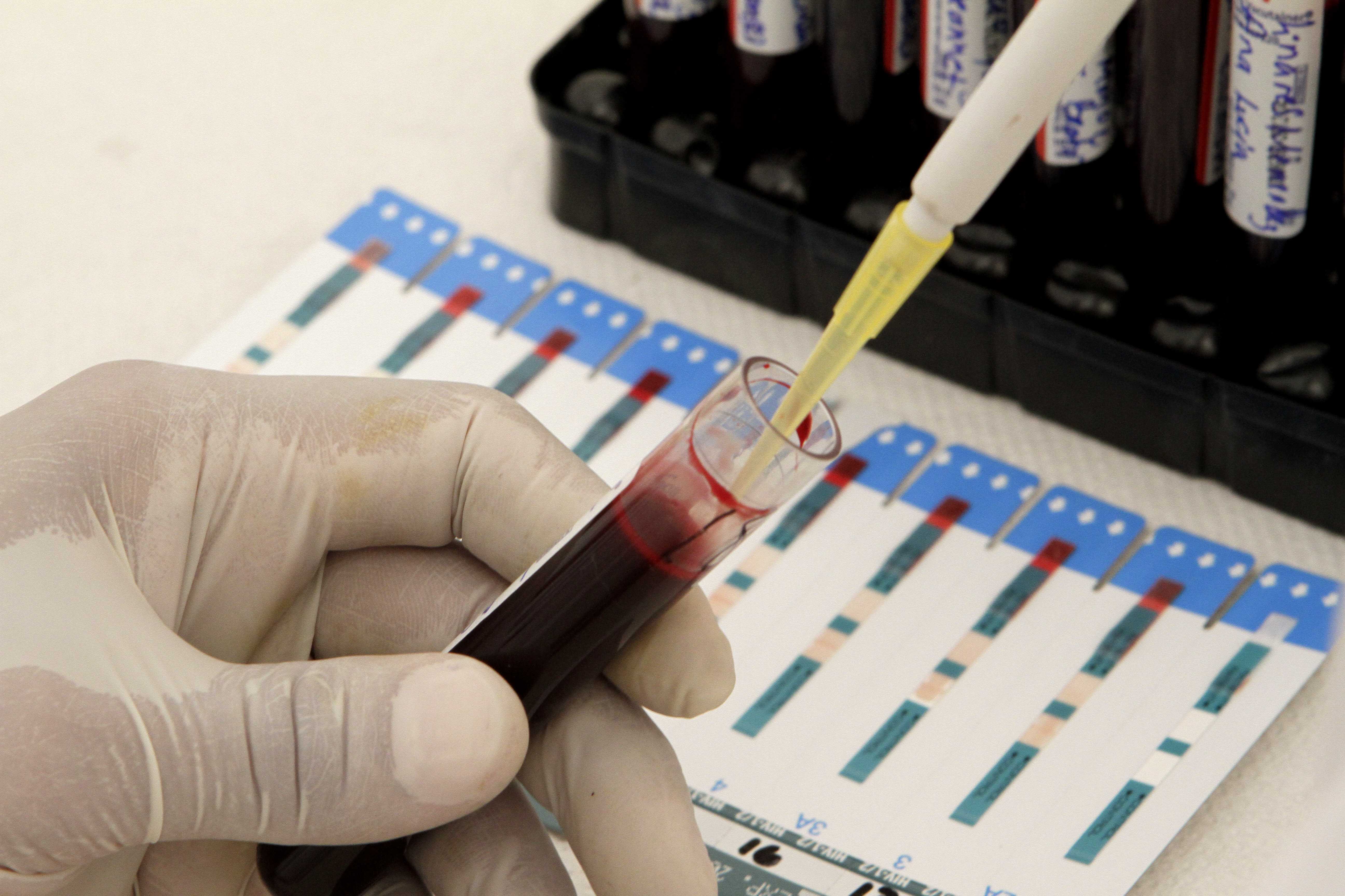 Лаборатория тест экспресс. Методы диагностики ВИЧ инфекции. Серологический метод ВИЧ. Методы выявления ВИЧ инфекции. Лабораторные исследования ВИЧ инфекции.