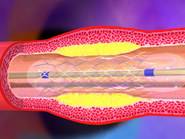 Αγγειοπλαστική μέσω του καρπού!