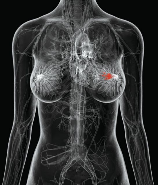 Γονίδιο «ένοχο» για τους δύσκολους καρκίνους του μαστού