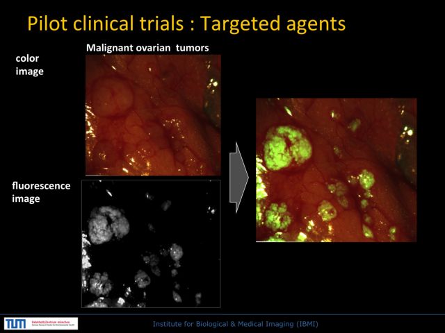 Φωσφορίζοντες όγκοι «οδηγοί» χειρουργών