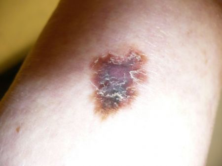 Διαθέσιμη και στην Ελλάδα συνδυαστική θεραπεία για το προχωρημένο μελάνωμα