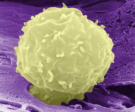 Βλαστοκύτταρα «πρώτων βοηθειών» μετά το εγκεφαλικό | tovima.gr