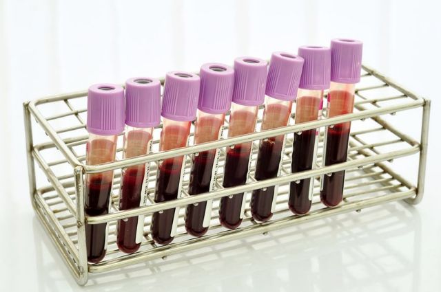 Πειραματική εξέταση αίματος υπόσχεται έγκαιρη διάγνωση της νόσου Αλτσχάιμερ