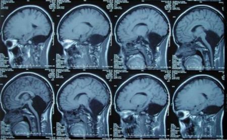 Μια γυναίκα που ζει χωρίς παρεγκεφαλίδα!