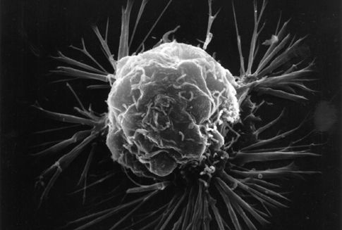 Καρκινικά κύτταρα μολύνουν υγιή με μόρια RNA | tovima.gr