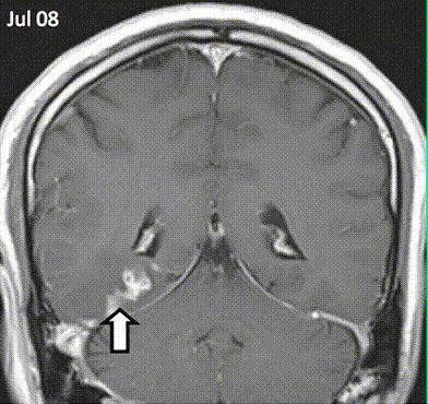 Διαβολικό σκουλήκι βρέθηκε να τρώει τον εγκέφαλο ασθενούς