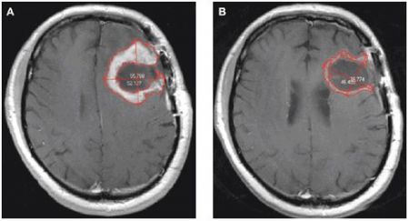 Ο διαβήτης προστατεύει από καρκίνο στον εγκέφαλο!