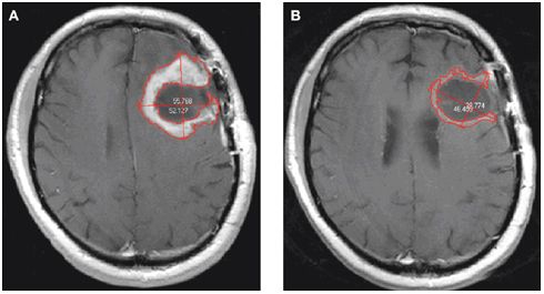 Ο διαβήτης προστατεύει από καρκίνο στον εγκέφαλο!