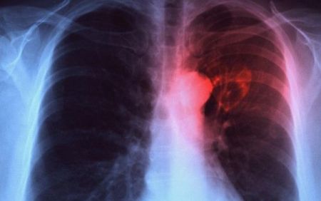 Συστήματα τεχνητής νοημοσύνης διαγιγνώσκουν τη φυματίωση