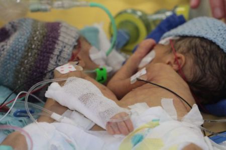 Σιαμαία κοριτσάκια διαχωρίστηκαν 8 ημέρες μετά τη γέννησή τους
