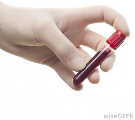 Νέα σύσταση για μέτρηση της χοληστερόλης στο αίμα χωρίς νηστεία