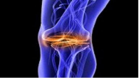 Εξατομικευμένη αρθροπλαστική γόνατος