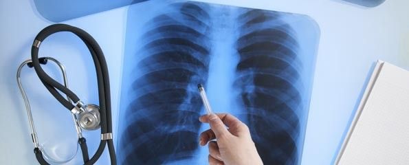 ΕΕ: Εγκρίθηκε νέα συνδυαστική θεραπεία για τον μη μικροκυτταρικό καρκίνο πνεύμονα