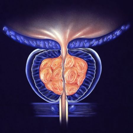 Stockholm3: Ο διάδοχος του PSA
