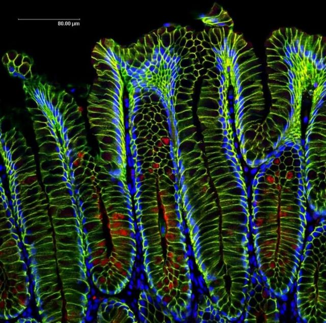 «Βακτηριακοί» καρκίνοι