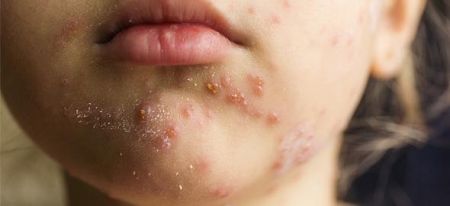 Εξι γιατροί Δημοσίων Νοσοκομείων έχουν προσβληθεί από ιλαρά