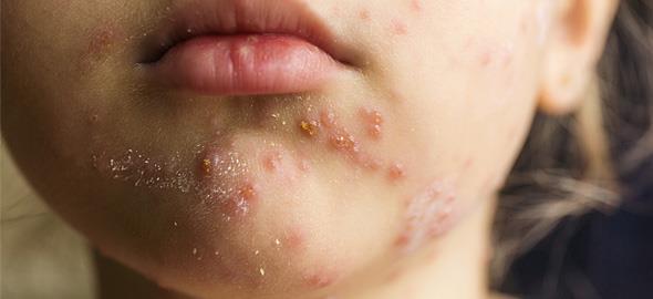 Εξι γιατροί Δημοσίων Νοσοκομείων έχουν προσβληθεί από ιλαρά