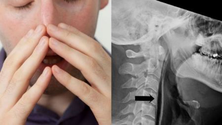 Κράτησε το φτέρνισμά του και προκάλεσε ρήξη στο λάρυγγά του