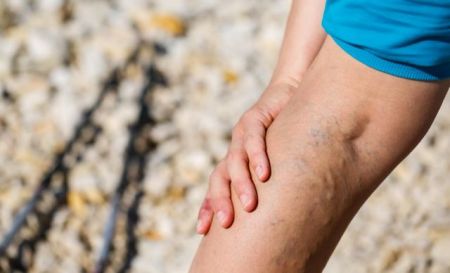 Οι κιρσοί αυξάνουν τον κίνδυνο εκδήλωσης θρόμβωσης