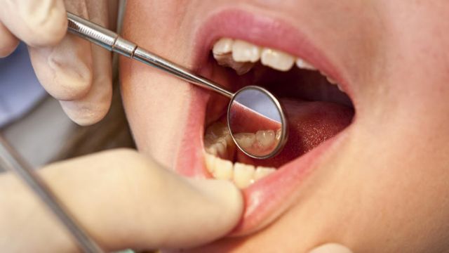 Το 60-90% των παιδιών σχολικής ηλικίας παγκοσμίως εμφανίζει οδοντική τερηδόνα
