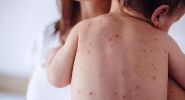 ΚΕΕΛΠΝΟ: Περισσότερα από 100 περιστατικά ιλαράς την τελευταία εβδομάδα