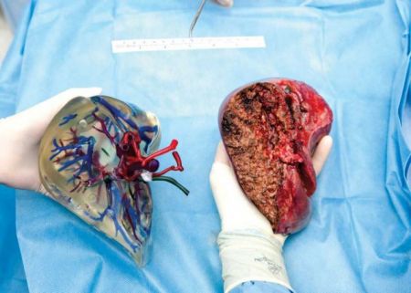 Προσομείωση χειρουργικής επέμβασης με 3D μοντέλα οργάνων