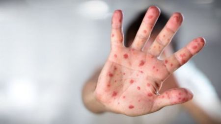 SOS από UNICEF για την έξαρση της ιλαράς
