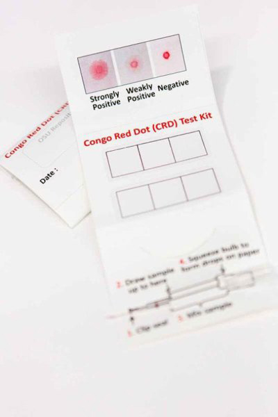 Τεστ ούρων ανιχνεύει την προεκλαμψία σε τρία λεπτά